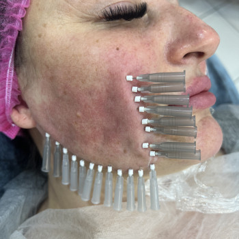 Тредліфтинг мезонитки
                    Косметолог-ін'єкціоніст Наталья Дніпро