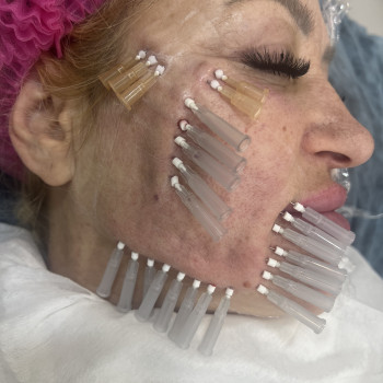 Тредліфтинг мезонитки
                    Косметолог-ін'єкціоніст Наталья Дніпро