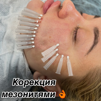 Тредліфтинг мезонитки
                    Косметолог-ін'єкціоніст Наталья Дніпро