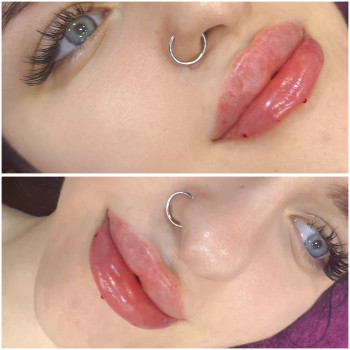 Контурна пластика губ #