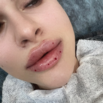 Збільшення губ
                    Косметолог-инъекционист Наталья Днепр