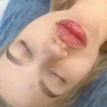 Збільшення губ
                    Косметолог-инъекционист Наталья Днепр