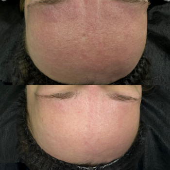 Чистка обличчя
                    Лікар-косметолог Ирина Краматорськ