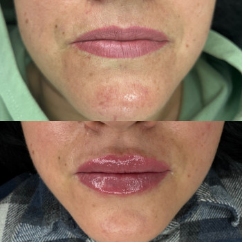 Контурна пластика губ
                    Врач-косметолог Ирина Краматорск