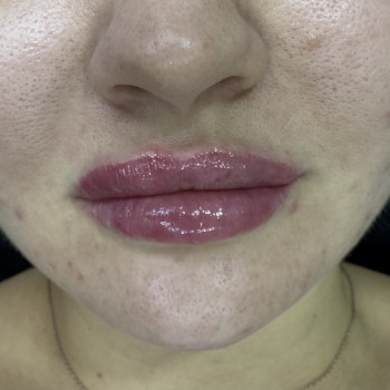 Контурна пластика губ
                    Врач-косметолог Ирина Краматорск