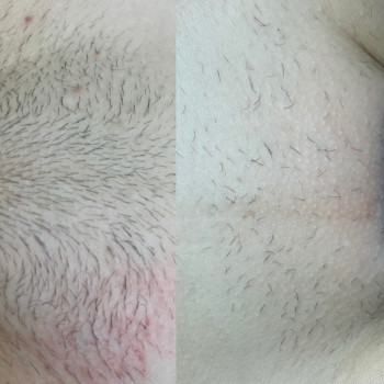 Електроепіляція
                    Электролог Олеся Киев