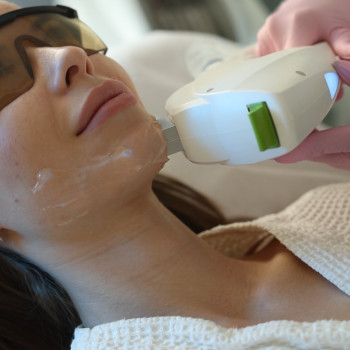 IPL фототерапія хмельницький
  пігментації
  куперозу
  судин