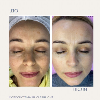 IPL фотоомолодження обличчя
 #видалення пігментації в хмельницькому