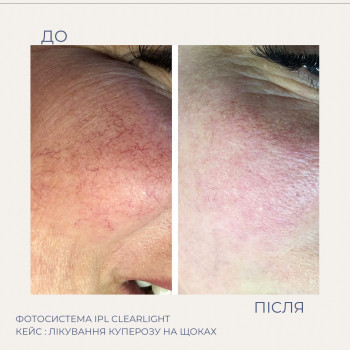 IPL видалення куперозу на обличчі
  куперозу хмельницький