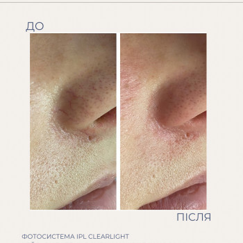 IPL фототерапія - видалення куперозу, судинної сітки, розацеа
                    Студия лазерной эпиляции Еліт Хмельницкий
