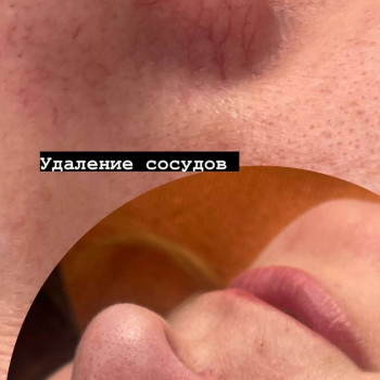 Удаление сосудов лазером
                    Майстер перманентного макіяжу Ирина Полтава