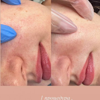 Удаление сосудов лазером
                    Майстер перманентного макіяжу Ирина Полтава