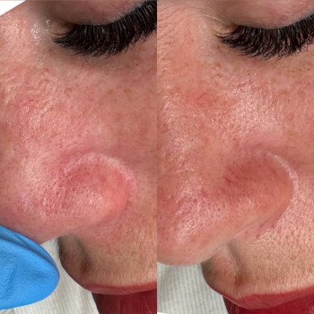 Удаление сосудов лазером
                    Майстер перманентного макіяжу Ирина Полтава