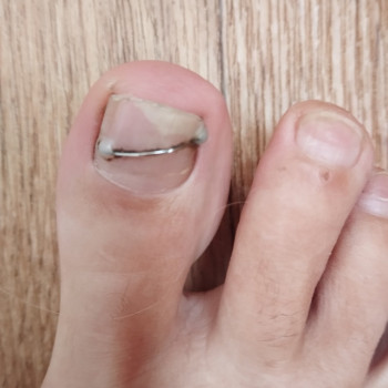 Обробка врослого нігтя
                    Подолог Ольга Одеса