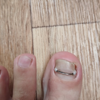 Обробка врослого нігтя
                    Подолог Ольга Одеса