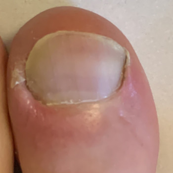 Обробка врослого нігтя
                    Подолог Ольга Одеса