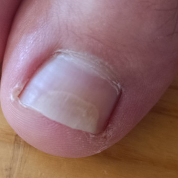 Обробка врослого нігтя
                    Подолог Ольга Одеса