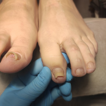 Обробка врослого нігтя
                    Подолог Ольга Одеса