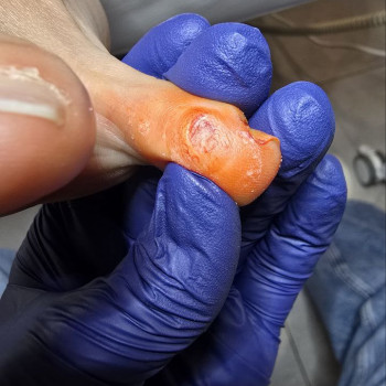 опік мозоля саліподом