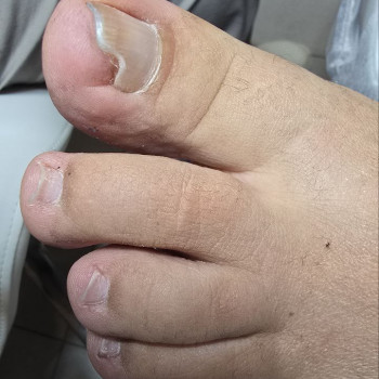 протезування до