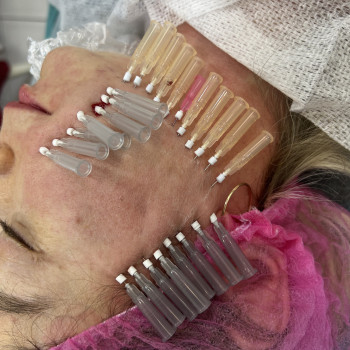 Процедура мезонитки для поліпшення якості шкіри та усунення вікових змін #