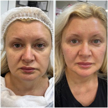 Корекція середньої третини обличчя #