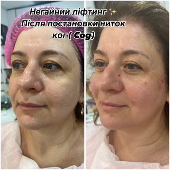 Корекція обличчя нитками ког #( 4 шт)