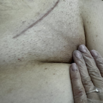 Депіляція бікіні після КР