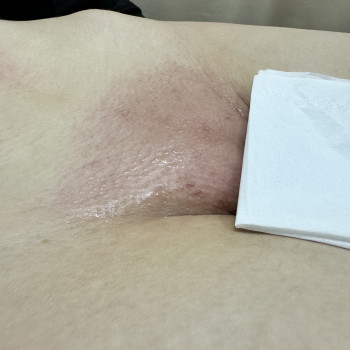 Депіляція бікіні після гоління