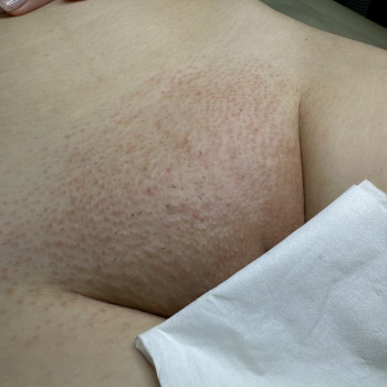 Депіляція бікіні за 30 хвилин