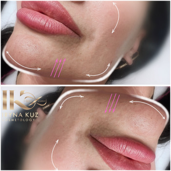 Кути нижньої щелепи та підборіддя