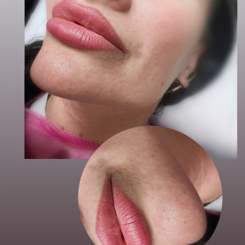 Контурна пластика
                    Косметолог-ін'єкціоніст Ірина Львів