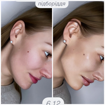 Контурна пластика
                    Косметолог-ін'єкціоніст Ірина Львів