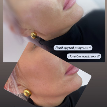 Контурна пластика
                    Косметолог-ін'єкціоніст Ірина Львів