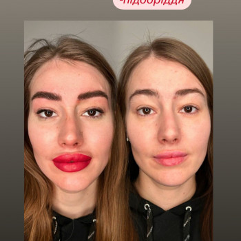 Тут зробили вилиці, кути, підборіддя та губи.