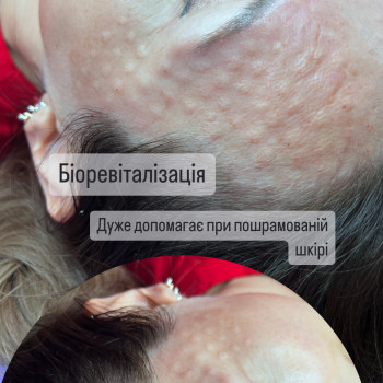 Біоревіталізація, мезотерапія, мезоботокс, коктейль Монако
                    Косметолог-инъекционист Ірина Львов