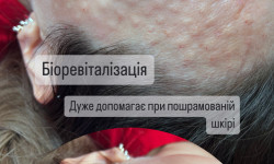 Біоревіталізація, мезотерапія, мезоботокс, коктейль Монако Косметолог-инъекционист Ірина Львов