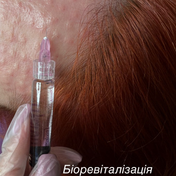 Біоревіталізація, мезотерапія, мезоботокс, коктейль Монако
                    Косметолог-инъекционист Ірина Львов