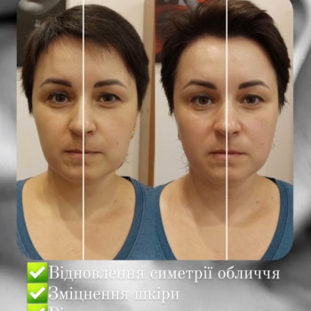 Результат 10 сеансів
Відновлення симетрії