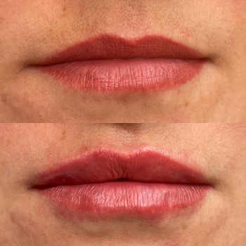 Аугментація губ філером. Виправлення асиметрії. Натурально.