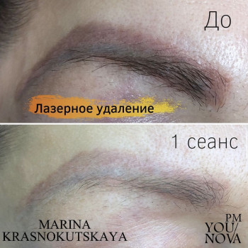 Лазерне видалення неякісного татуажу.