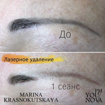 Лазерне видалення неякісного татуажу.