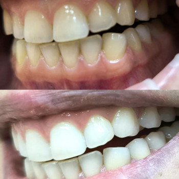 Експрес відбілювання 30 хв 🦷👄