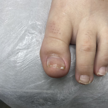 Травма нігтя
                    Подолог Наталья Львов