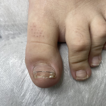 Травма нігтя
                    Подолог Наталья Львов