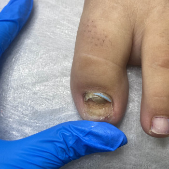 Травма нігтя
                    Подолог Наталья Львов