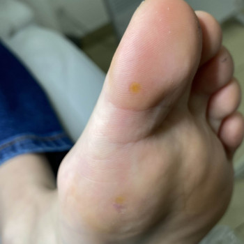 Бородавки
                    Подолог Наталья Львів