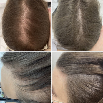 Лікування випадіння волосся.