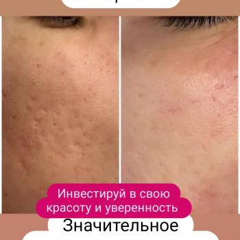 Мікроігольчастий RF-ліфтинг
                    Косметолог Дарья Одесса