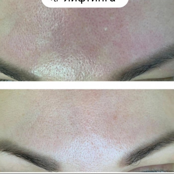 Мікроігольчастий RF-ліфтинг
                    Косметолог Дарья Одесса